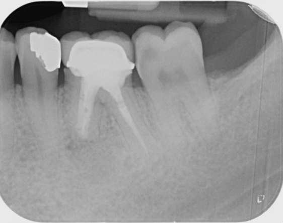 Molar apicectomy - Review radiograph demonstrating healing
